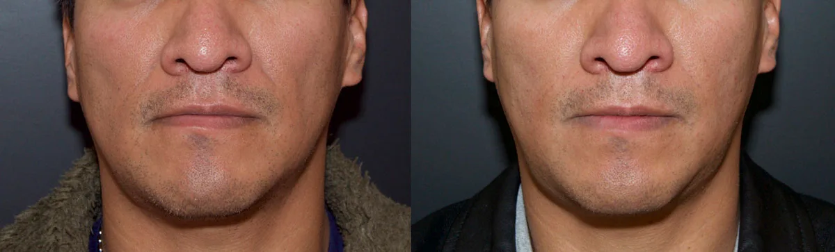 Tratamiento facial con ácido hialurónico en CDMX