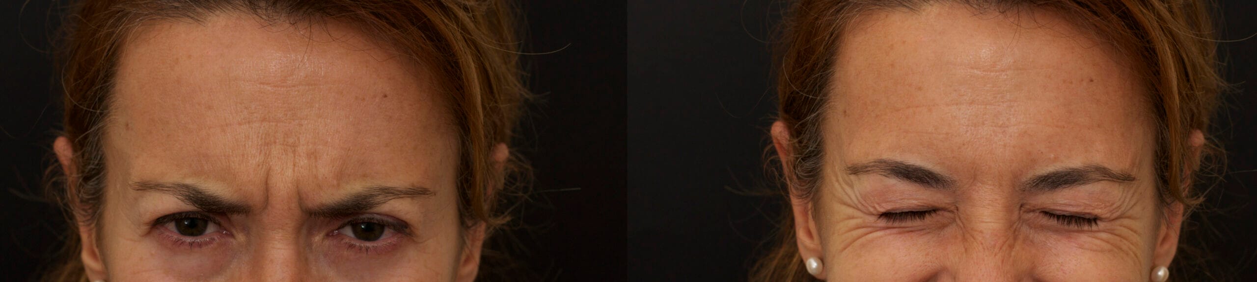 Toxina botulínica en cara y cuello: Guía Médica y Clínica