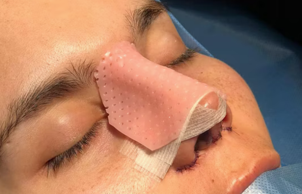 Recuperación de Rinoplastia: Guía semana a semana