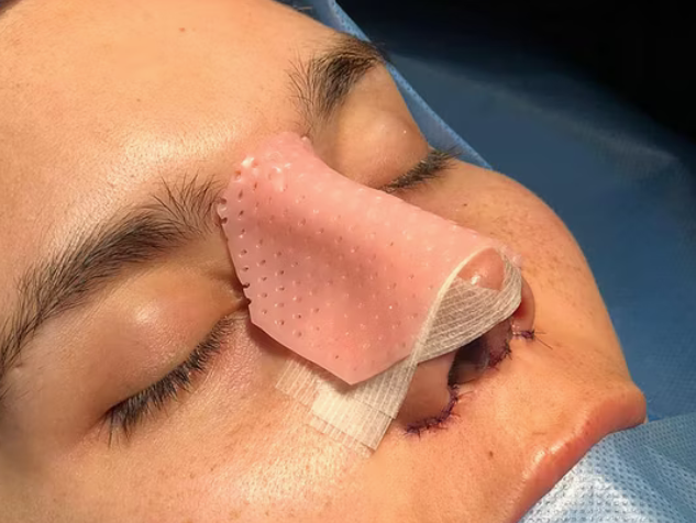 Recuperación de Rinoplastia: Guía semana a semana