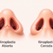 "rinoplastia abierta vs cerrada — Dr. José Luis Sanjurjo, otorrinolaringólogo en CDMX"