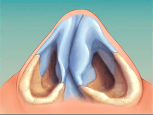 Diferencia entre rinoplastia y septoplastia explicada por el Dr. José Luis Sanjurjo