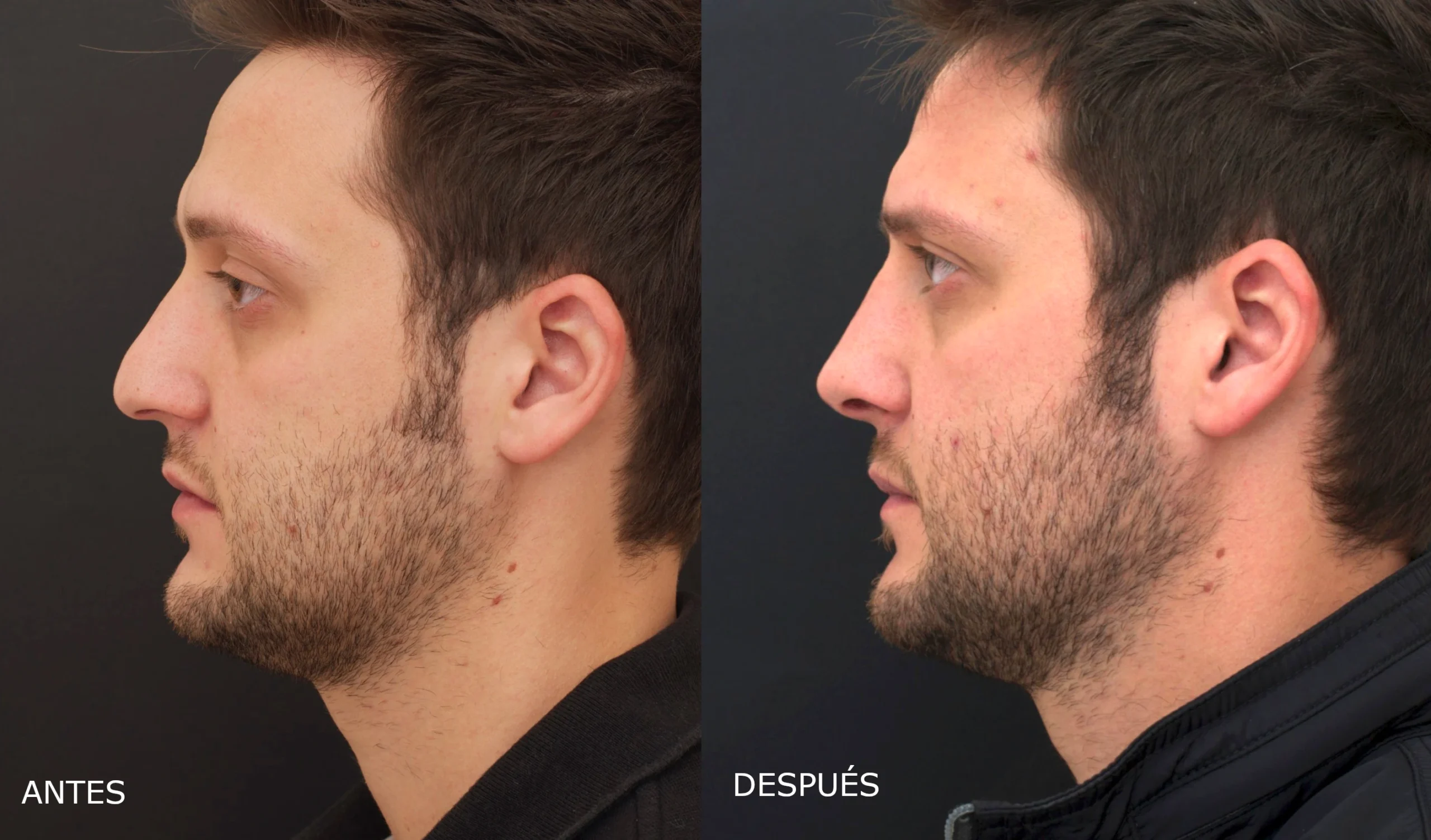 Rinoplastia masculina antes y después