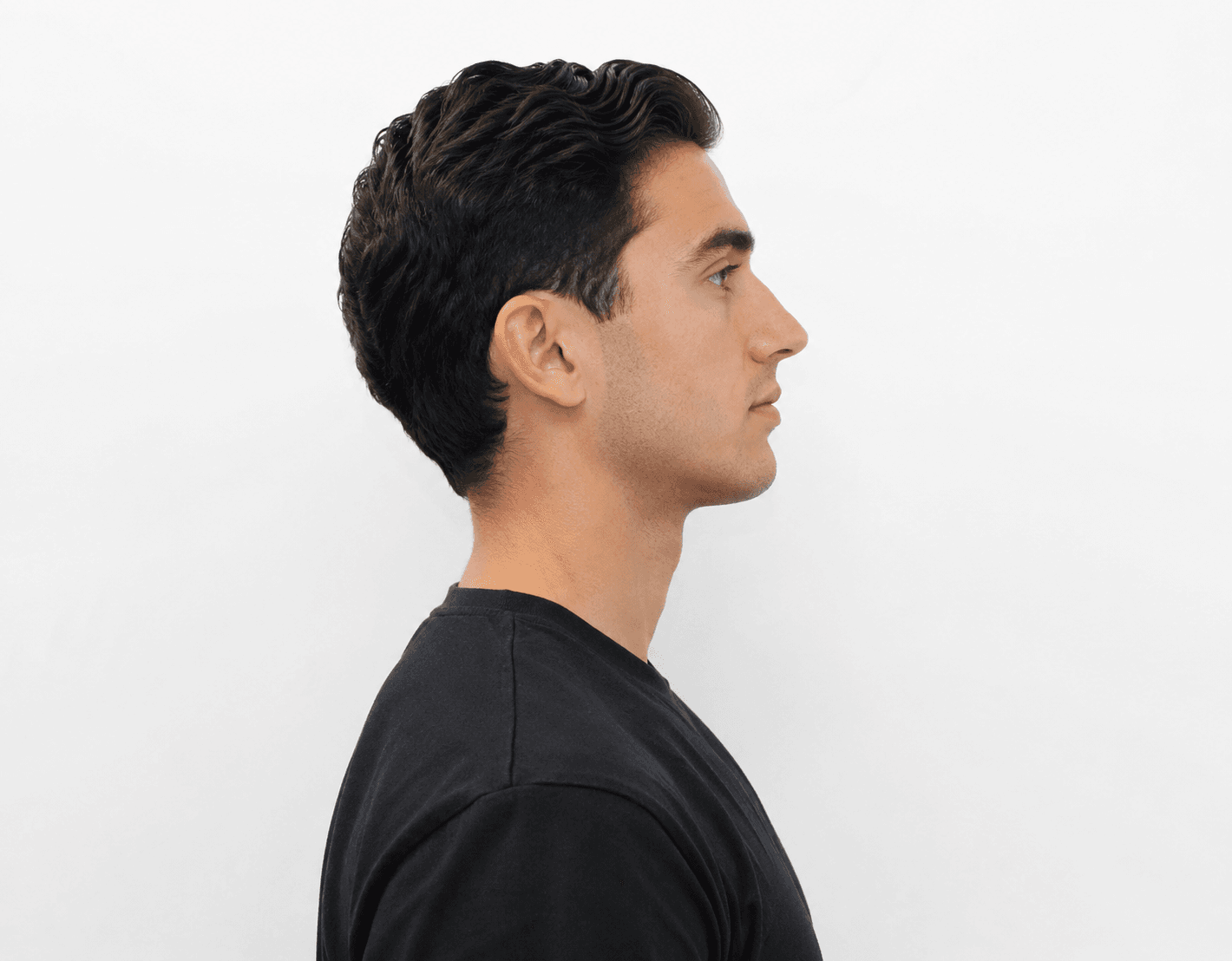 Rinoplastia ultrasónica para hombres en CDMX — perfil masculino antes y después con dorso recto y ángulos anatómicos preservados