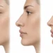 Comparación conceptual entre rinomodelación y rinoplastia en el perfil nasal