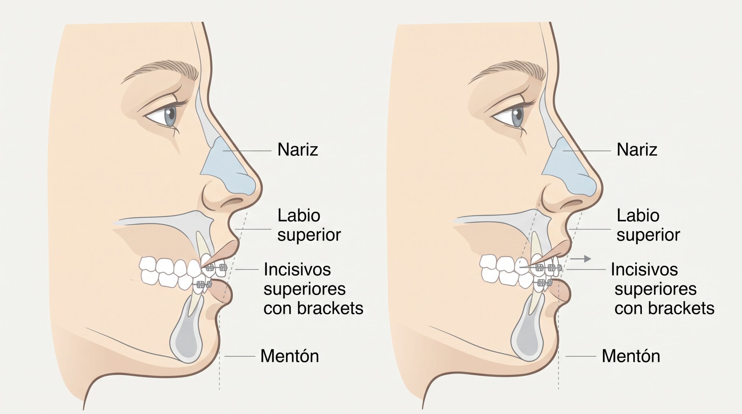 Esquema anatómico de la relación entre incisivos superiores, labio superior y perfil nasal