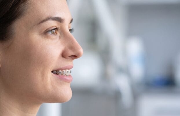 Rinoplastia y brackets: ¿qué conviene hacer primero?