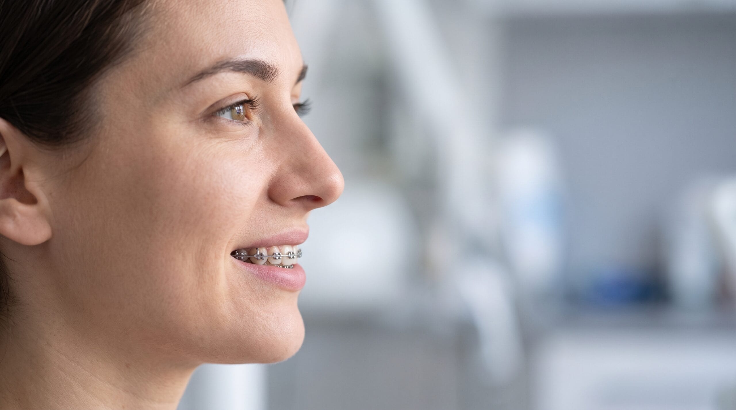 Rinoplastia y brackets: ¿qué conviene hacer primero?